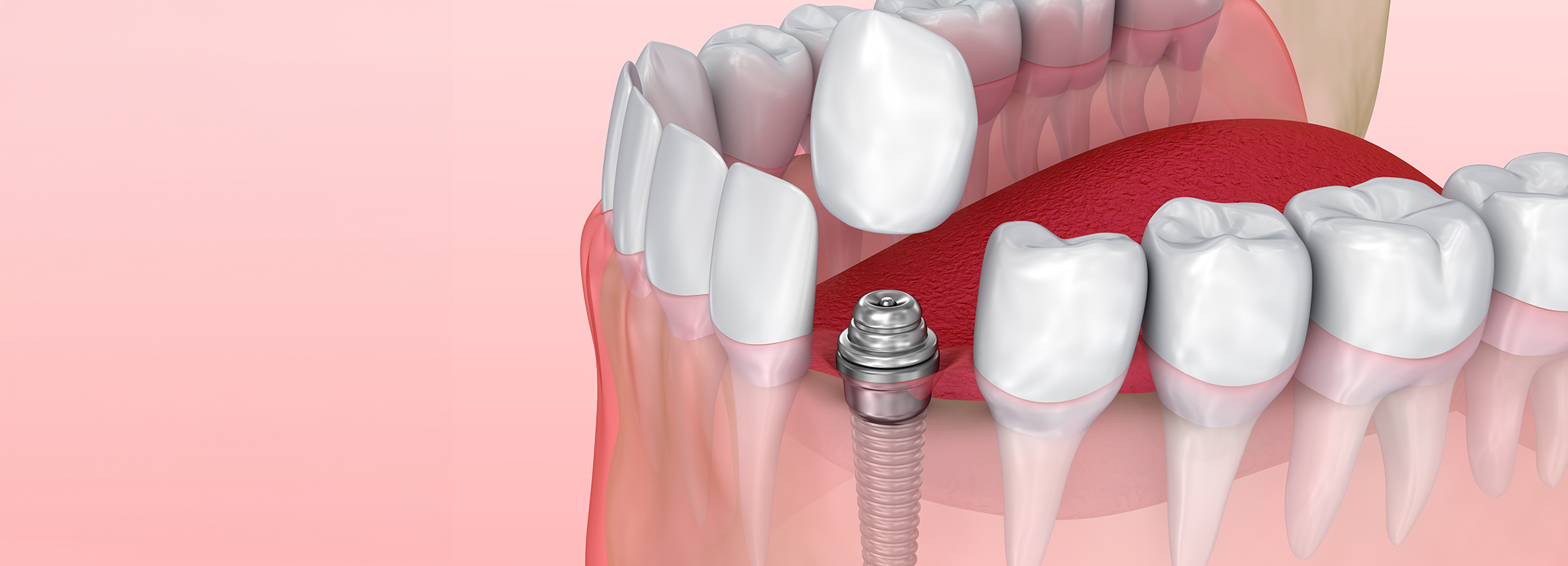 「治療期間の短縮」抜歯即時インプラントを積極的に採用